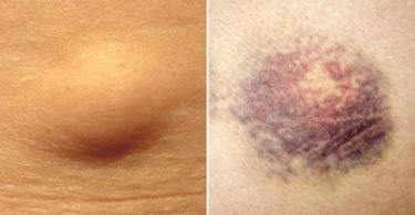 Difference Between Lipoma and Hematoma