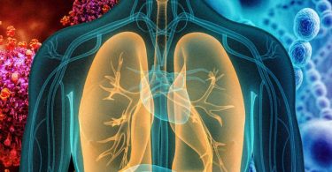 Chest infection is an expansive phrase that encircles any parasitic, fungal, bacterial, or viral infection that occurs anywhere in the respiratory system and has to do with the upper and lower respiratory tract.