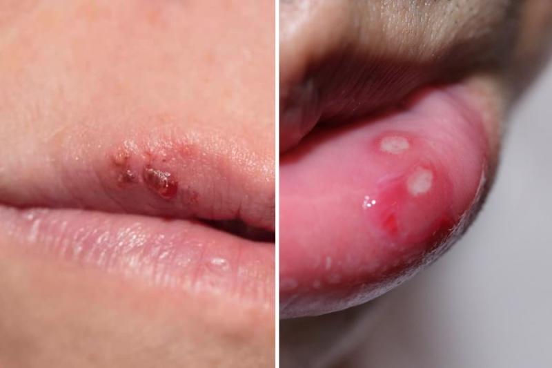 Difference Between Mouth Ulcer and Cold Sore