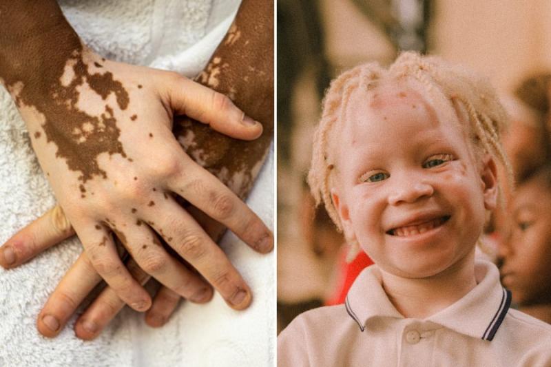 Difference Between Leucoderma and Albinism
