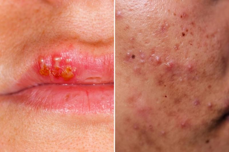 Difference Between Cold Sore and Pimple