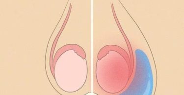 Difference Between Hydrocele and Varicocele