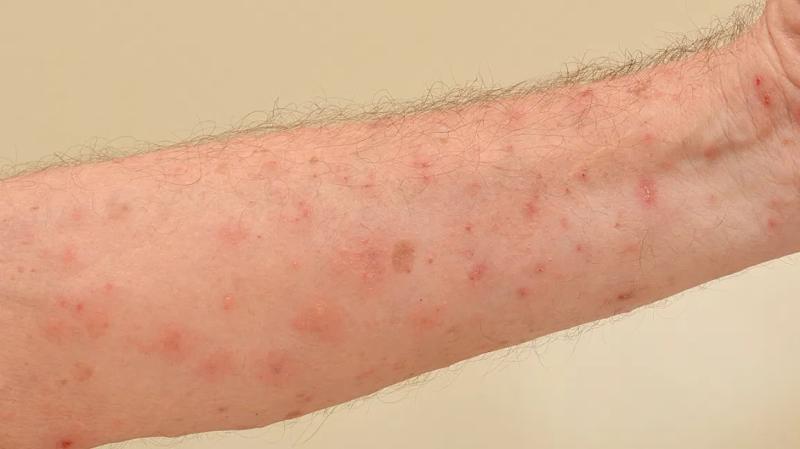 The significant difference between scabies and urticaria is based on their description. Scabies is described as skin rashes as a result of a mite referred to as Sarcoptes scarbiei. Urticaria, on the other hand, is described as a skin rash resulting from an allergic response to food or something individuals have touched. Skin rashes are usually red, dry, bumpy, inflamed, itchy, and painful.