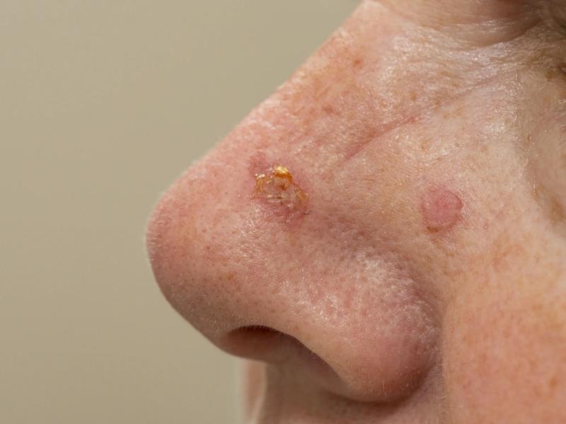 The significant difference between actinic disease and Bowen's disease indicates that actinic keratosis is a skin disorder that triggers smaller red, pink, skin-colored, or gray scaly, inflated dots on the skin.
