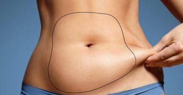 The significant difference between liposuction and gastric bypass indicates that liposuction is a cosmetic process in which too many fat residues under the skin are taken out via tiny cuts. In contrast, gastric bypass is a medical process that provides an individual with a total and highly dramatic weight loss and takes out all weight-connected conditions. Liposuction and gastric bypass are two processes to lessen an individual's weight. Liposuction can reduce about 2 to 8 pounds, whereas gastric bypass impacts extreme theatrical weight loss. Liposuction is naturally not beneficial in managing obesity; however, gastric bypass lectures about the underlying triggers of obesity.