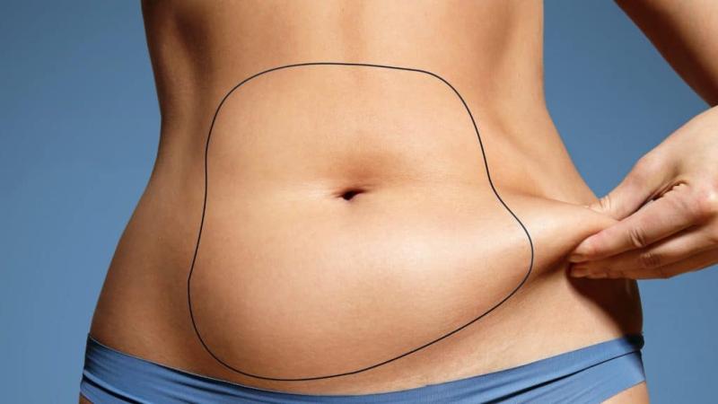 The significant difference between liposuction and gastric bypass indicates that liposuction is a cosmetic process in which too many fat residues under the skin are taken out via tiny cuts. In contrast, gastric bypass is a medical process that provides an individual with a total and highly dramatic weight loss and takes out all weight-connected conditions. Liposuction and gastric bypass are two processes to lessen an individual's weight. Liposuction can reduce about 2 to 8 pounds, whereas gastric bypass impacts extreme theatrical weight loss. Liposuction is naturally not beneficial in managing obesity; however, gastric bypass lectures about the underlying triggers of obesity.