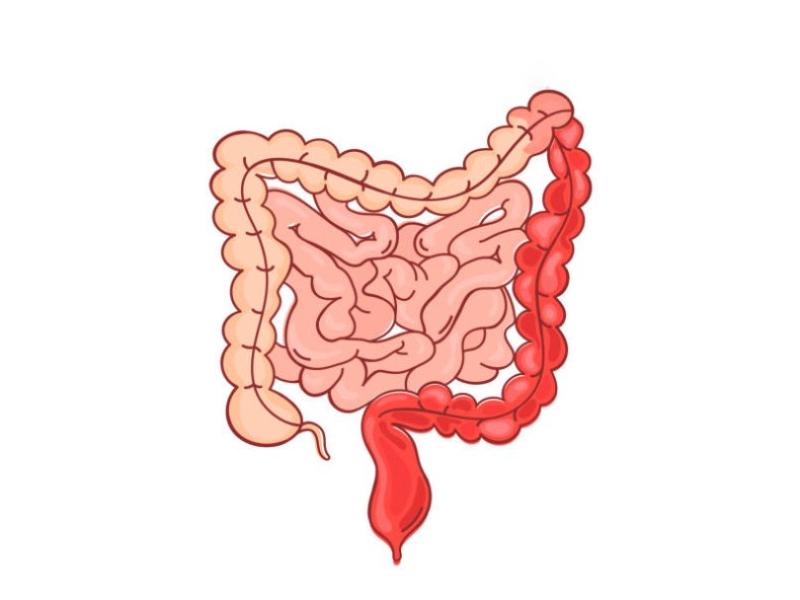 The primary difference between colitis and proctitis is that colitis is a medical disorder that influences the colon of the big intestine. In contrast, proctitis is a medical disorder that influences the rectum of the big intestine.